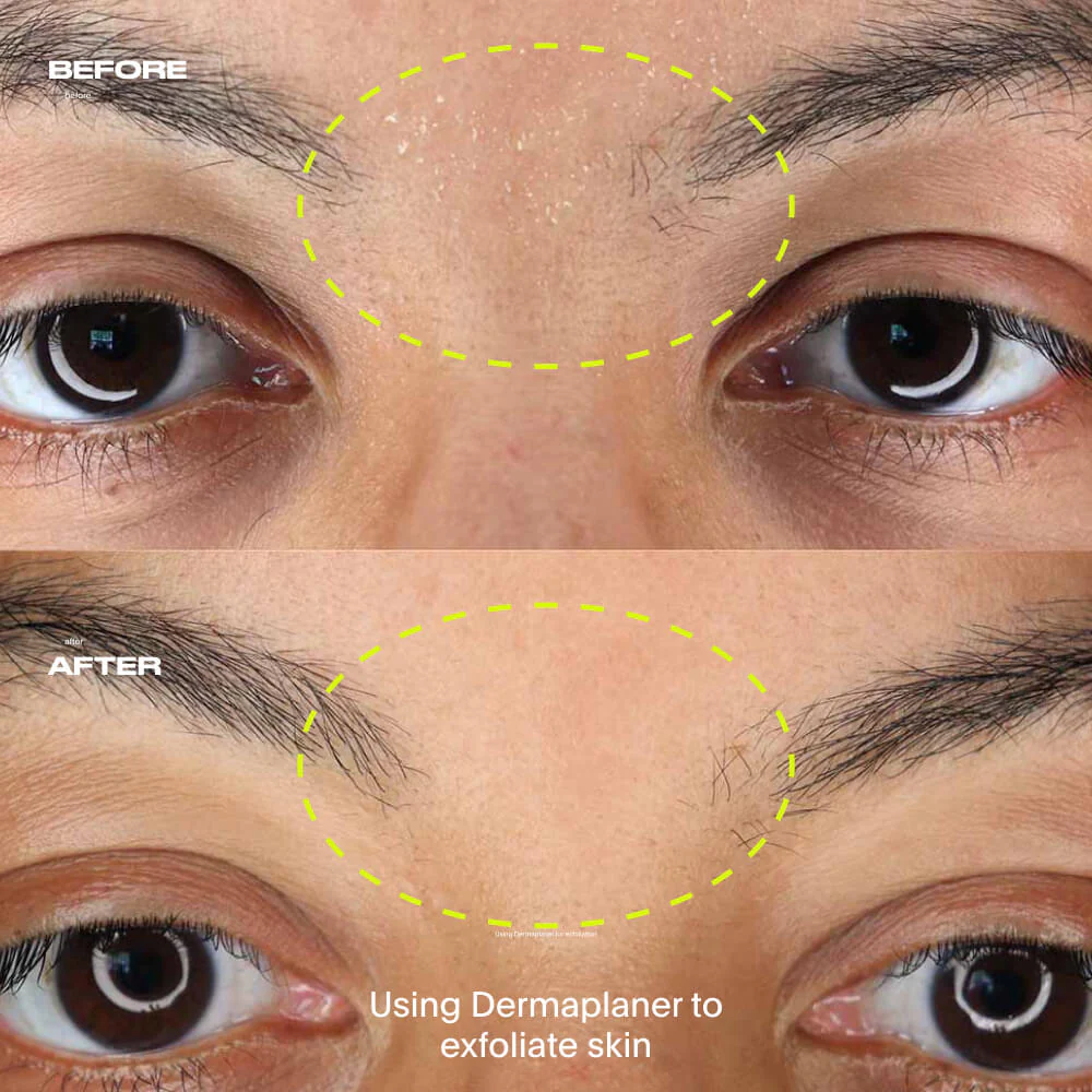 Dermaplaner Kit, Fig - Image 6